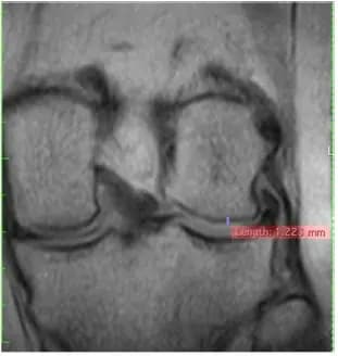 Coronal knee MRI plate at baseline